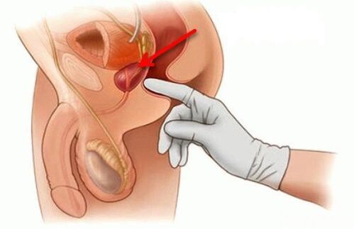 masaje prostático para la prostatitis